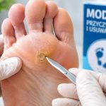 Modzele na stopach — pumeks, krem z kwasem salicylowym, plastry hydrokoloidowe. U podologa frezowanie, krioterapia.