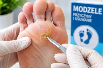 Modzele na stopach — pumeks, krem z kwasem salicylowym, plastry hydrokoloidowe. U podologa frezowanie, krioterapia.