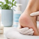Pęknięte pięty — leczenie kremem z mocznikiem, plastry hydrokoloidowe Compeed, profilaktyka codzienna.